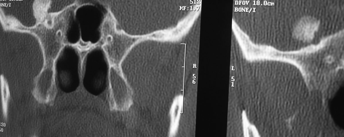 Brain  Left Middle Cranial Fossa Osteoma (2)