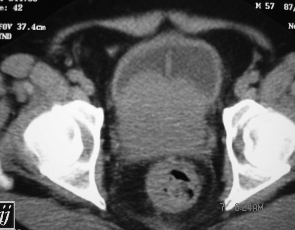 Abdomen  Prostate Tumor (2)