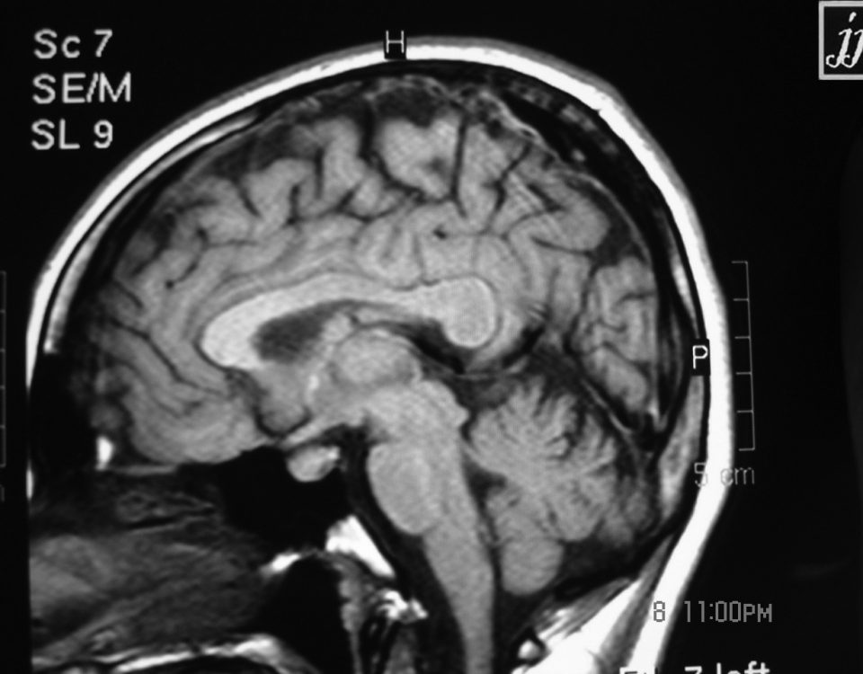 Brain  Thick Corpus Callosum Variant (10)