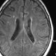Brain  Cavernomatosis (11)
