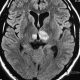 Brain  Cerebellar Lesion (11)