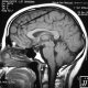 Brain  Frontal Meningioma (4)
