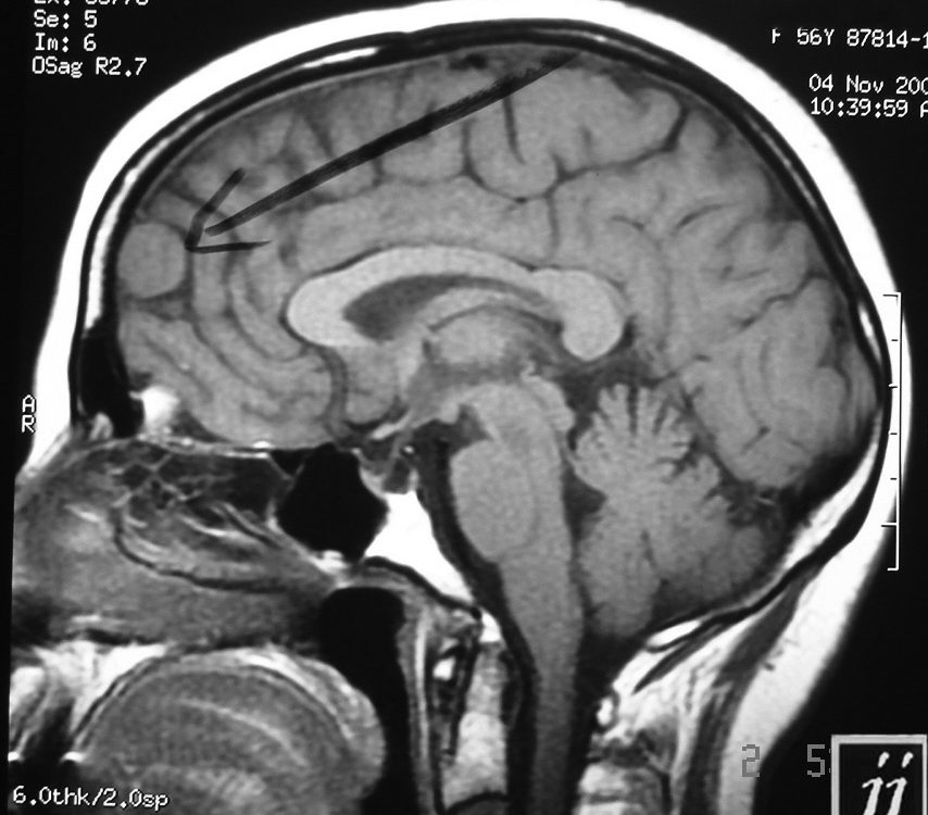 Brain  Frontal Meningioma (4)