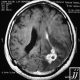 Brain  Fungal Infection ( Rare Case) (11)