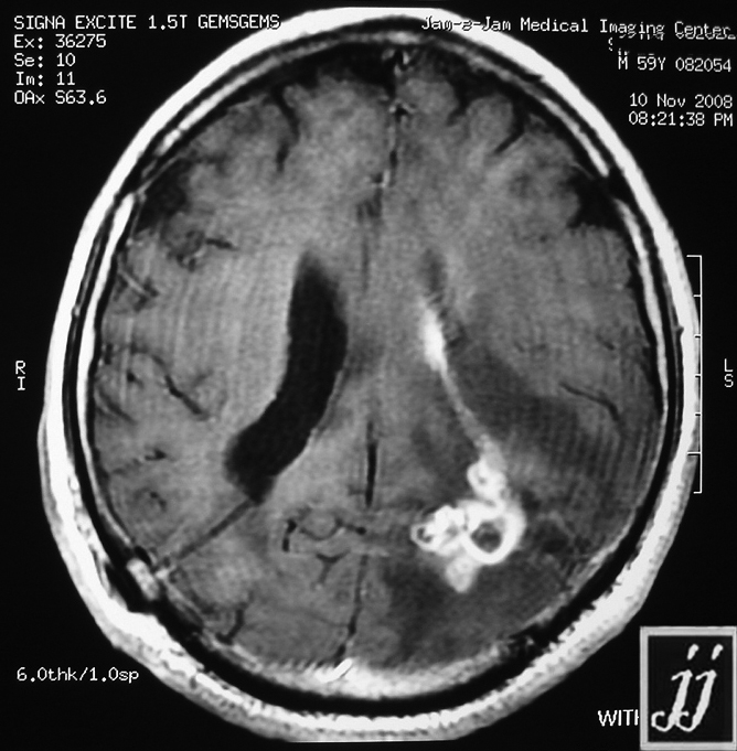 Brain  Fungal Infection ( Rare Case) (11)