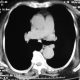 Chest  High AP Diameter And Herniated Lung Into Mediastinum (3)