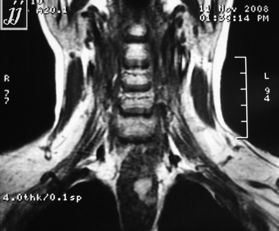ENT  Esophagus Lesion (4)