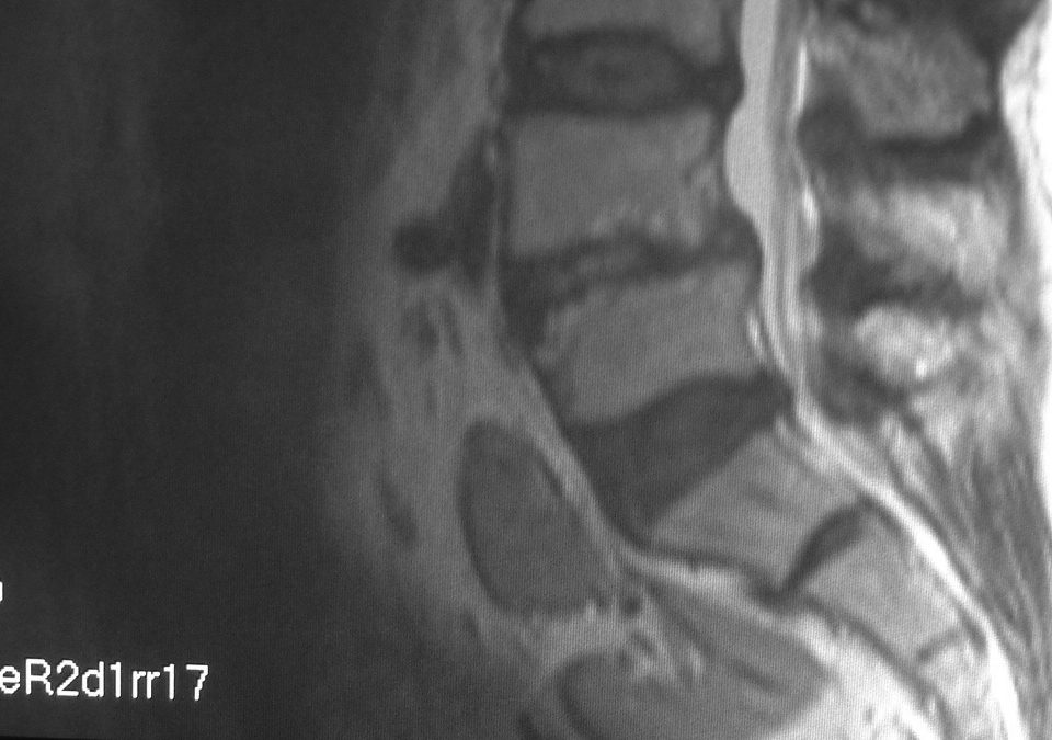 ENT  L4 L5 Antelisthesis And Disc Herniation (2)