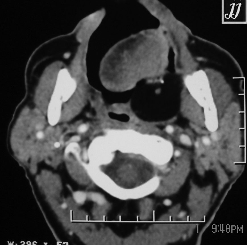 Palatine Tonsil And Adenoid Tissue Radiopaedia