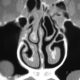 ENT  Sinusitis And Rare Left Inferior Turbinate Conchae Bulosa And Right Middle Conchae Bulosa ( Rare Case) (2)