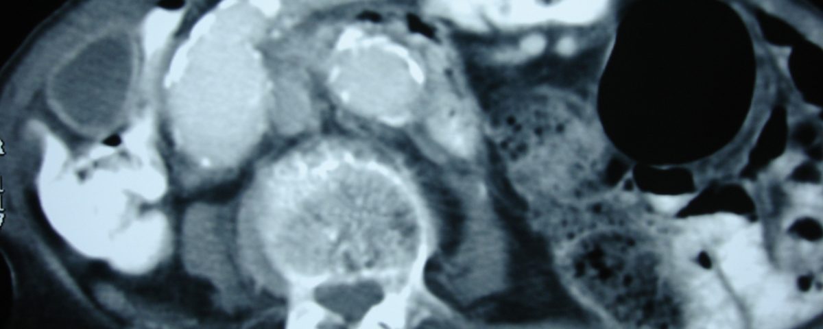 Abdomen  Iliac Vessels Aneurism And Mural Thrombosis (6)