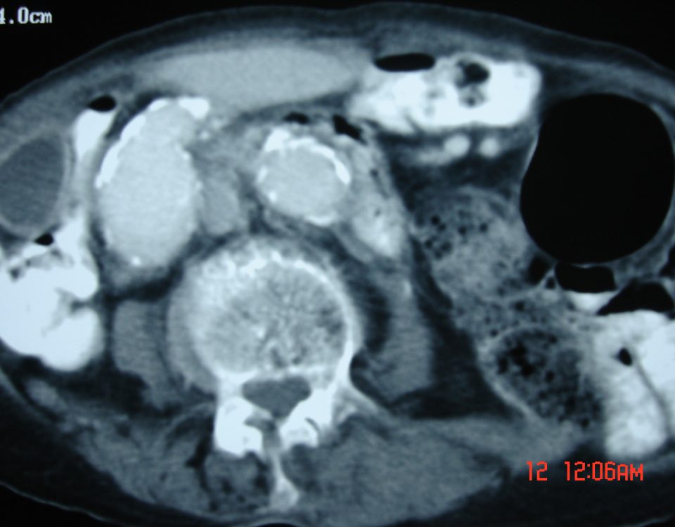 Abdomen  Iliac Vessels Aneurism And Mural Thrombosis (6)
