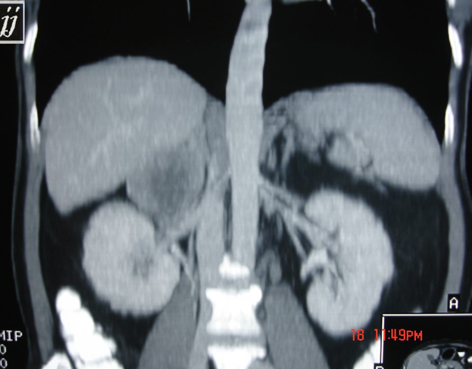 Abdomen  Adrenal Mass (2)