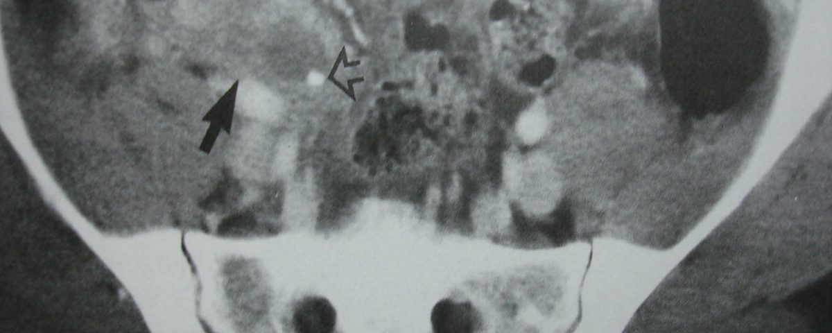 Abdomen  Appendix Abscess, Referenced Image