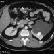 Abdomen  Cystic Tumor Of Kidney (2)