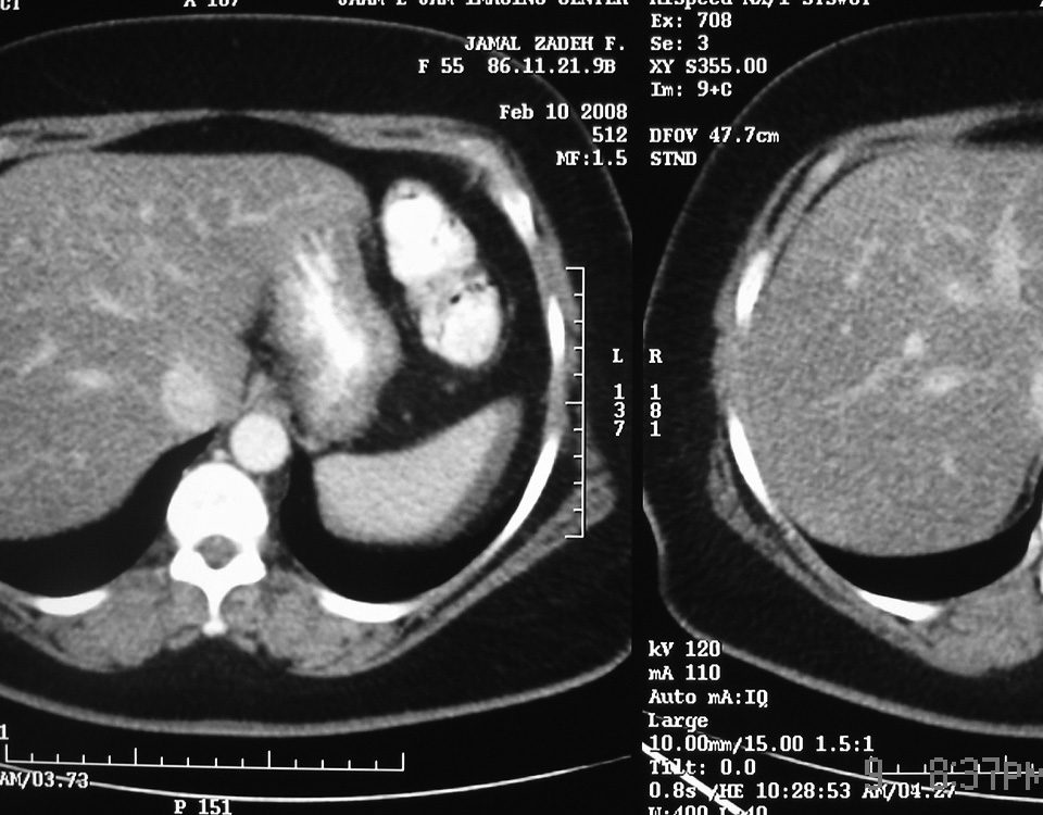 Abdomen  Fatty Liver (2)