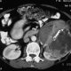 Abdomen  Left Kidney Tumor (28)