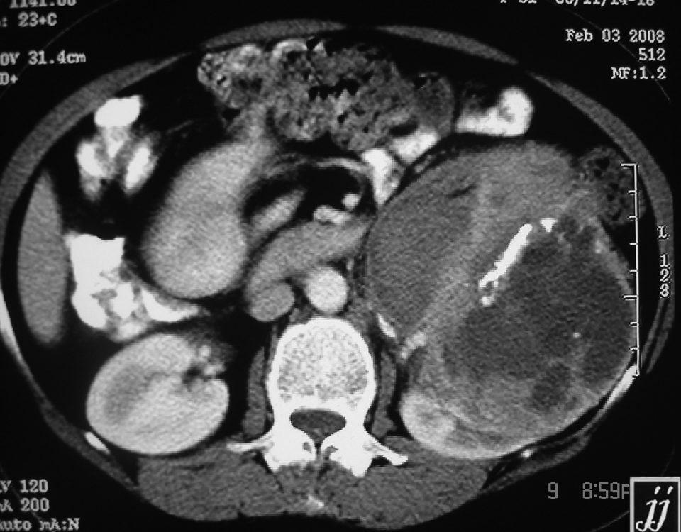 Abdomen  Left Kidney Tumor (28)