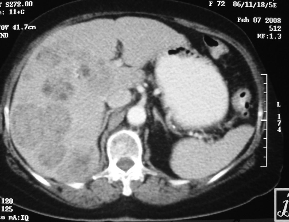 Abdomen  Operated For Pancreas Islet Cell Tumor (2)