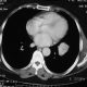 Abdomen  Uterus Sarcoma Metastasis (6)