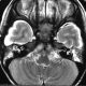 Brain  Bilateral Subdural Hygroma, ITP, Bilateral COM