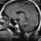 Brain  Cavernous Hemangioma Of Cerebellum Containing Met Hemoglobin Superimposed On MRA (17)