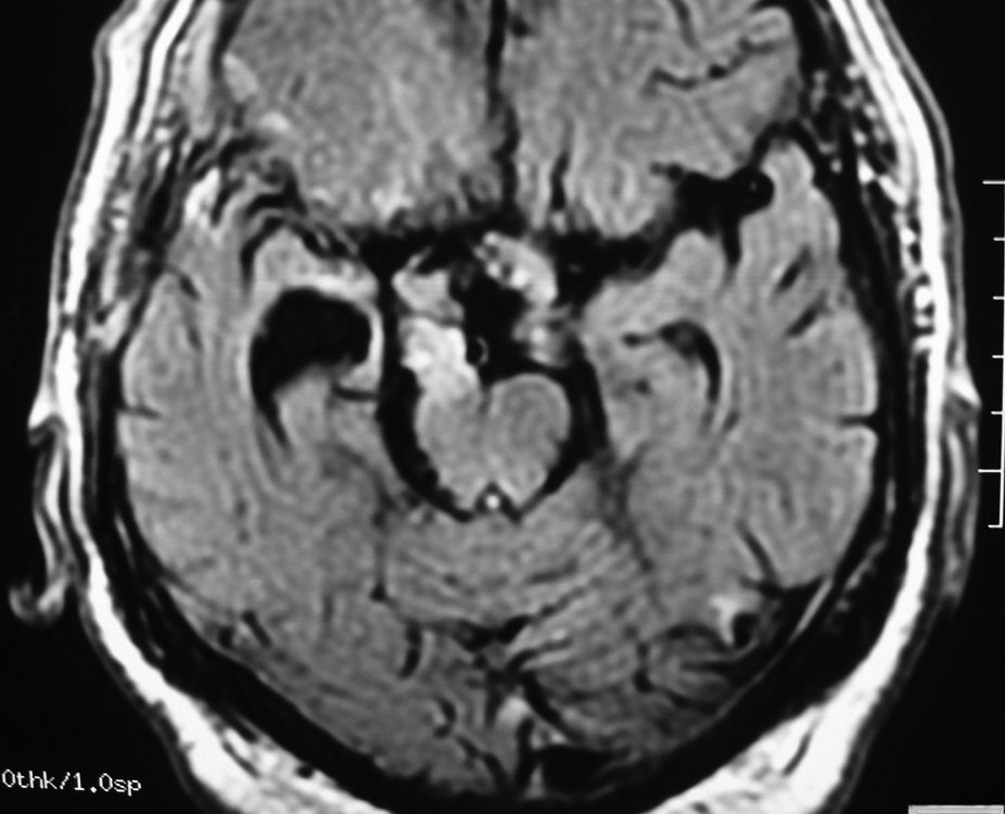 Brain  Craniopharyngioma (9)