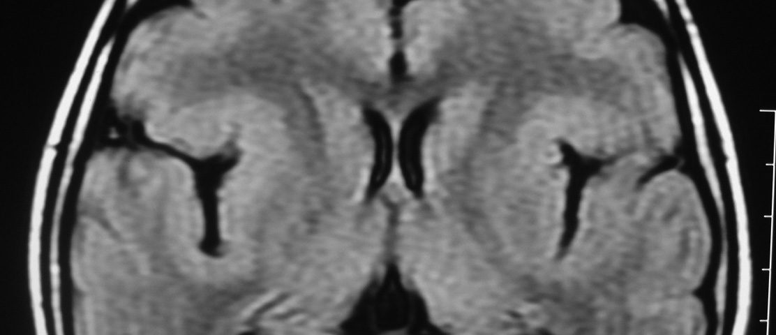 Brain  Ectopic Or Heterotopic Grey Mater Around Sylvian Fisher, Sylvian Syndrome (4)