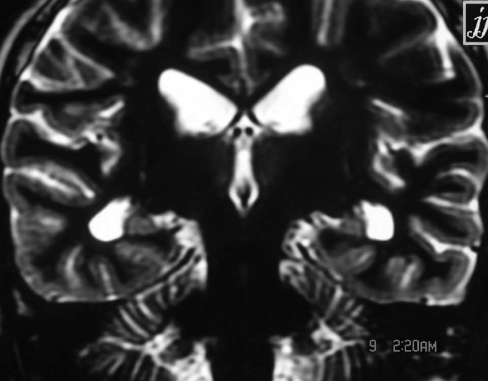 Brain  Hippocampus Atrophy (3)