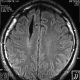 Brain  Interacerebral Hematoma In Shrinkage (4)