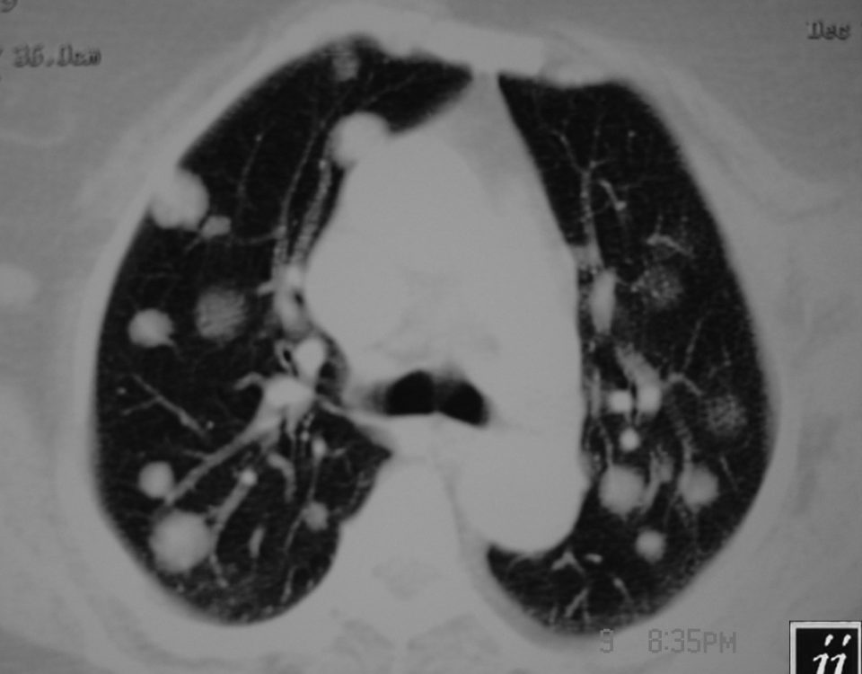 Chest  Lung Metastasis From Left Breast Tumor, Axillary Nodes (3)