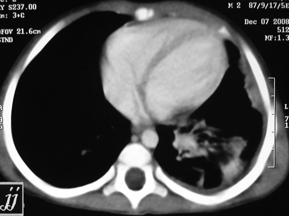 Chest  Left Lung Cavitated Tumor