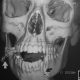 ENT  3D Of Facial Mandibular Fractures (2)