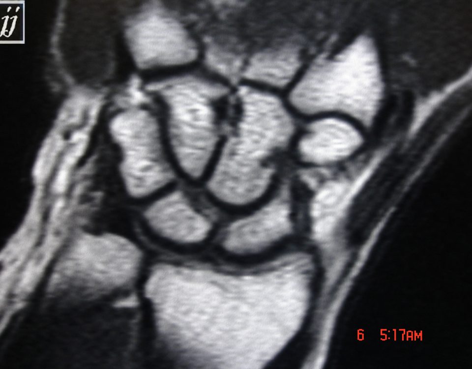 MSK  Scaphoid Cyst (2)