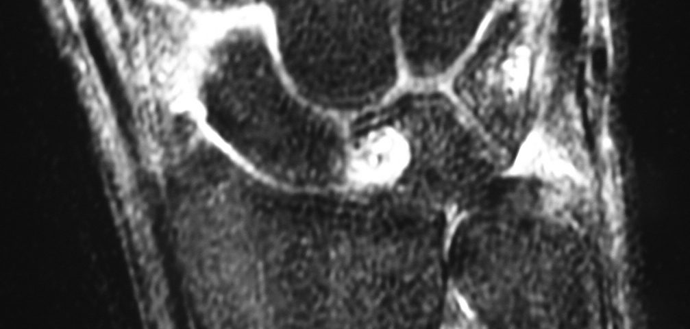 MSK  A Cyst In Lunate And Fluid Around Scaphoid (3)