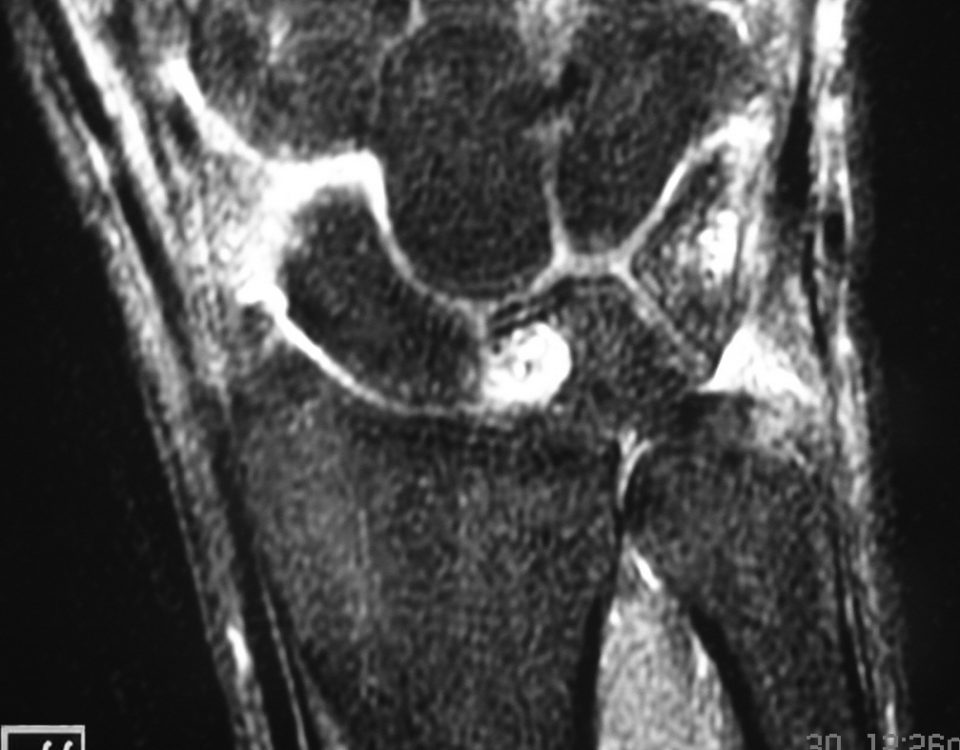 MSK  A Cyst In Lunate And Fluid Around Scaphoid (3)