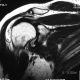 MSK  Large Effusion In Sab Acromial Space And Deltoid Bursa (9)