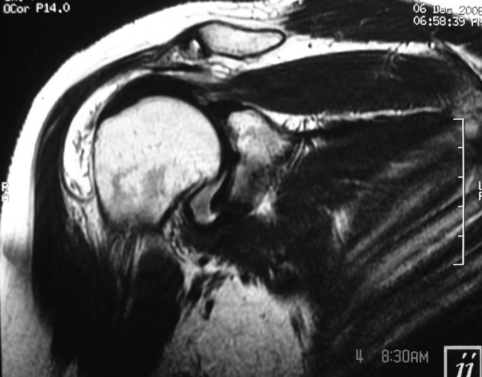 MSK  Large Effusion In Sab Acromial Space And Deltoid Bursa (9)