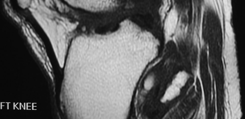 MSK  Loose Bodies In Tibio Fibular Recess (9)