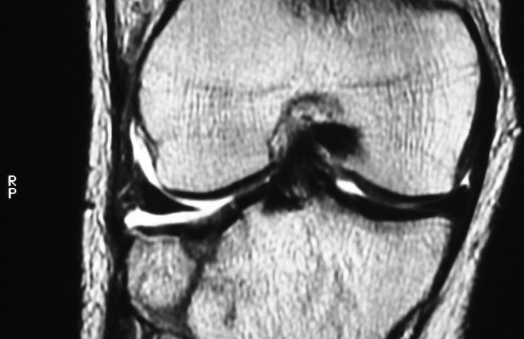 MSK  Tibial Fracture (5)