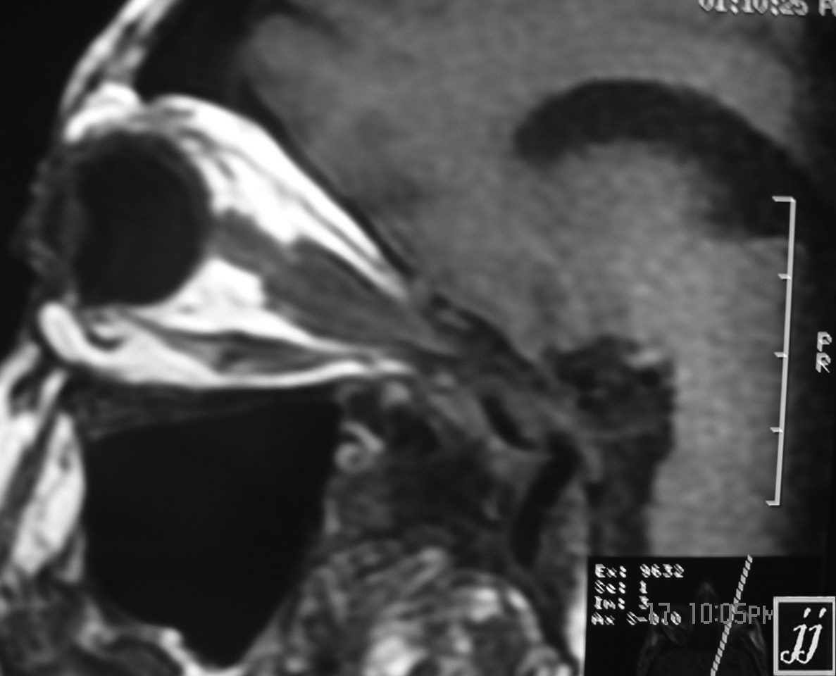 Optic Nerve Sheet Tumor Radiopaedia 