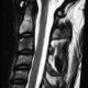 Spine  C3 Sclerosis