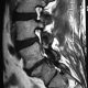 Spine  CT Mylography Laminectomy And Scar (9)