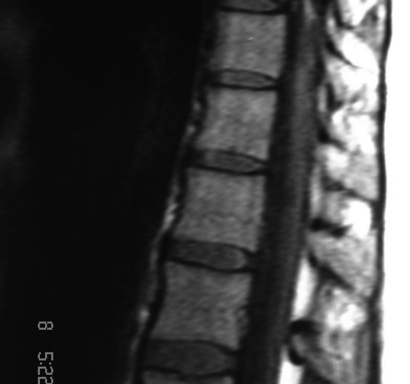 Spine  D10 D11 Facet Enlargement (2)