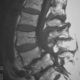 Spine  L4 Antelisthesis (3)