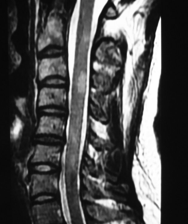 Spine  MS