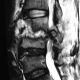 Spine  Tuberculosis (3)