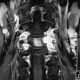 Spine  A Process Around Vertebral Artery (6)