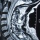 Spine  Abnormal Cord (2)
