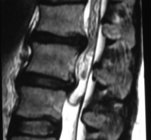 Spine  Cauda Equina Lipoma (2)